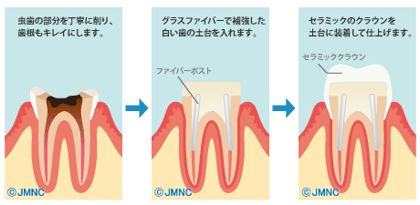 セラミッククラウン
