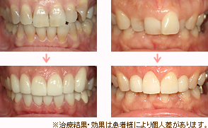審美歯科治療の治療例