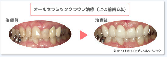 オールセラミックの治療例
