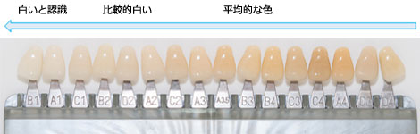 歯の色見本表“シェードガイド” 歯の色見本表“シェードガイド”
