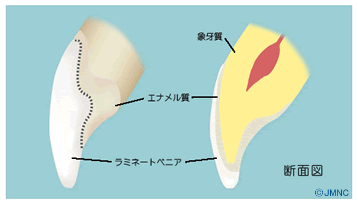 付け爪のようなセラミック