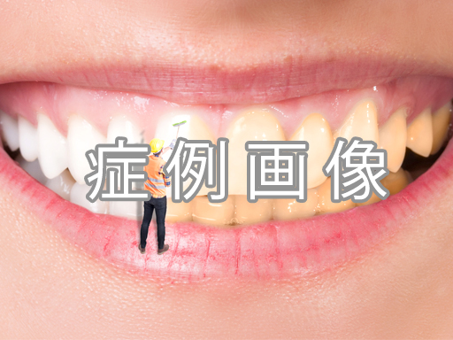 お悩み別のセラミック矯正施術例