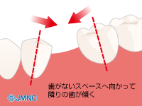 歯がないスペースへ向かって隣の歯が傾く