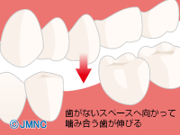 歯がないとどうなるの？歯をうしなった時のお口の中と治療法