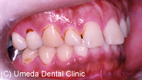 治療前_前歯の隙間（隙を改善）