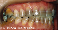 治療前_抗生物質の色素沈着