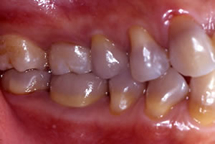 治療後_セラミッククラウン ハイブリッドインレーの治療例 ©hdhc ふちはた歯科