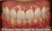 治療後_症例写真】ラミネートベニアで前歯６本の歯の色を改善した例