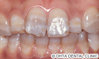 治療前_テトラサイクリン着色歯が重症の場合（下顎の歯はホワイトニング