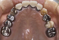治療前_歯に違和感を感じていた69歳の女性のケース ©Apollonia odictoligy department
