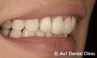 治療後_症例1：前歯4歯ジルコニアの症例写真