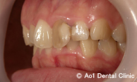 治療前_症例1：前歯4歯ジルコニアの症例写真