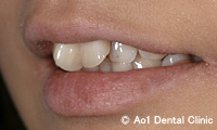 治療前_症例2：前歯6歯ジルコニアの症例写真