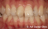 治療前_症例2：前歯6歯ジルコニアの症例写真