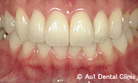 治療後_症例2：前歯6歯ジルコニアの症例写真