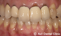 治療前_症例2：5歯ジルコニアの症例写真