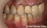 治療前_症例2：5歯ジルコニアの症例写真