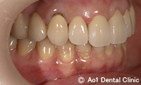 治療後_症例2：5歯ジルコニアの症例写真