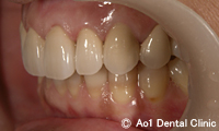 治療後_症例2：5歯ジルコニアの症例写真