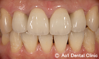 治療後_症例3：4歯ジルコニアの症例写真