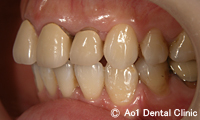 治療前_症例3：4歯ジルコニアの症例写真