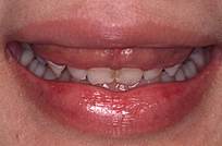 治療前_症例２、歯ぐきの膨らみ、ガミースマイル（歯ぐきの見え過ぎ）を治すため、歯肉整形後、ラミネートベニア治療を行った症例