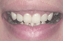 治療後_症例２、歯ぐきの膨らみ、ガミースマイル（歯ぐきの見え過ぎ）を治すため、歯肉整形後、ラミネートベニア治療を行った症例