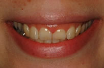 治療前_症例３、歯の形、歯ぐきの見え過ぎを治すため、歯肉整形後、ラミネートベニア治療を行った症例