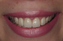 治療後_症例３、歯の形、歯ぐきの見え過ぎを治すため、歯肉整形後、ラミネートベニア治療を行った症例