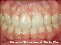 治療後_すきっ歯をラミネートべニアで治した症例-1