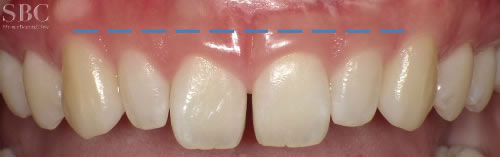 治療前_前歯の隙間と歯茎が見えすぎるお悩み