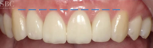 治療後_前歯の隙間と歯茎が見えすぎるお悩み