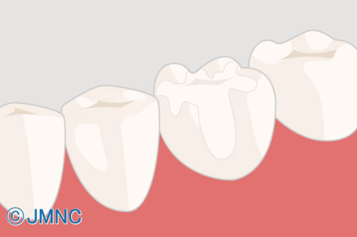 オールセラミックって何？素材や治療の流れを解説！