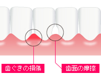 自宅で行う簡単ケア 歯間ブラシ