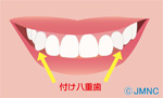 八重歯は付けられる！あえてプラスしたい方への提案