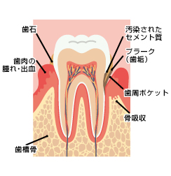 歯周病とアンチエイジング