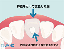 神経を取った後に変色!?神経のない歯のホワイトニング方法とは