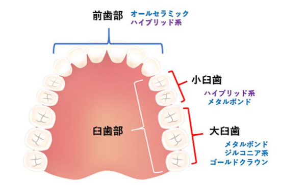 各素材が適している歯の場所