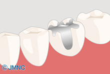 審美歯科治療は保険診療と自由診療で違う？詰め物や被せ物、治療の違いについて