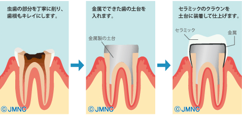 差し歯の治療法 差し歯の治療法