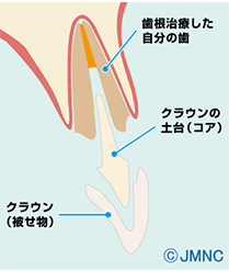 見た目をきれいにする差し歯とインプラント、決定的な違いはなに？