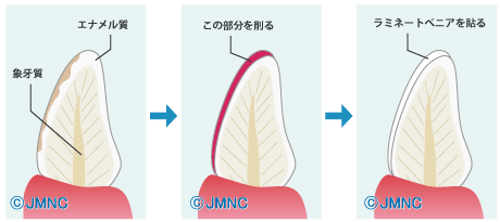 ラミネートべニアとは 治療の回数、流れについて