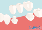ブリッジってどんな治療?公的医療保険は使える?