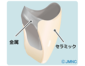 メタルボンド