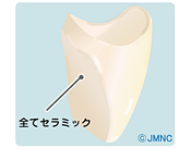 オールセラミッククラウン