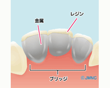 前歯のブリッジに使われる被せ物～メタルボンド・オールセラミック 