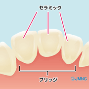 前歯のブリッジに使われる被せ物～メタルボンド・オールセラミック・レジン～