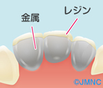 保険の白い前歯でお悩みの方へ。白い前歯は自費の被せ物がきれい！