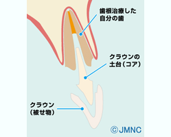差し歯の構造図 差し歯の構造図