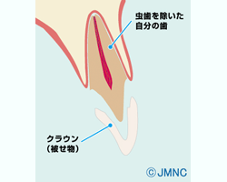 クラウン(被せ物)の構造図 クラウン(被せ物)の構造図